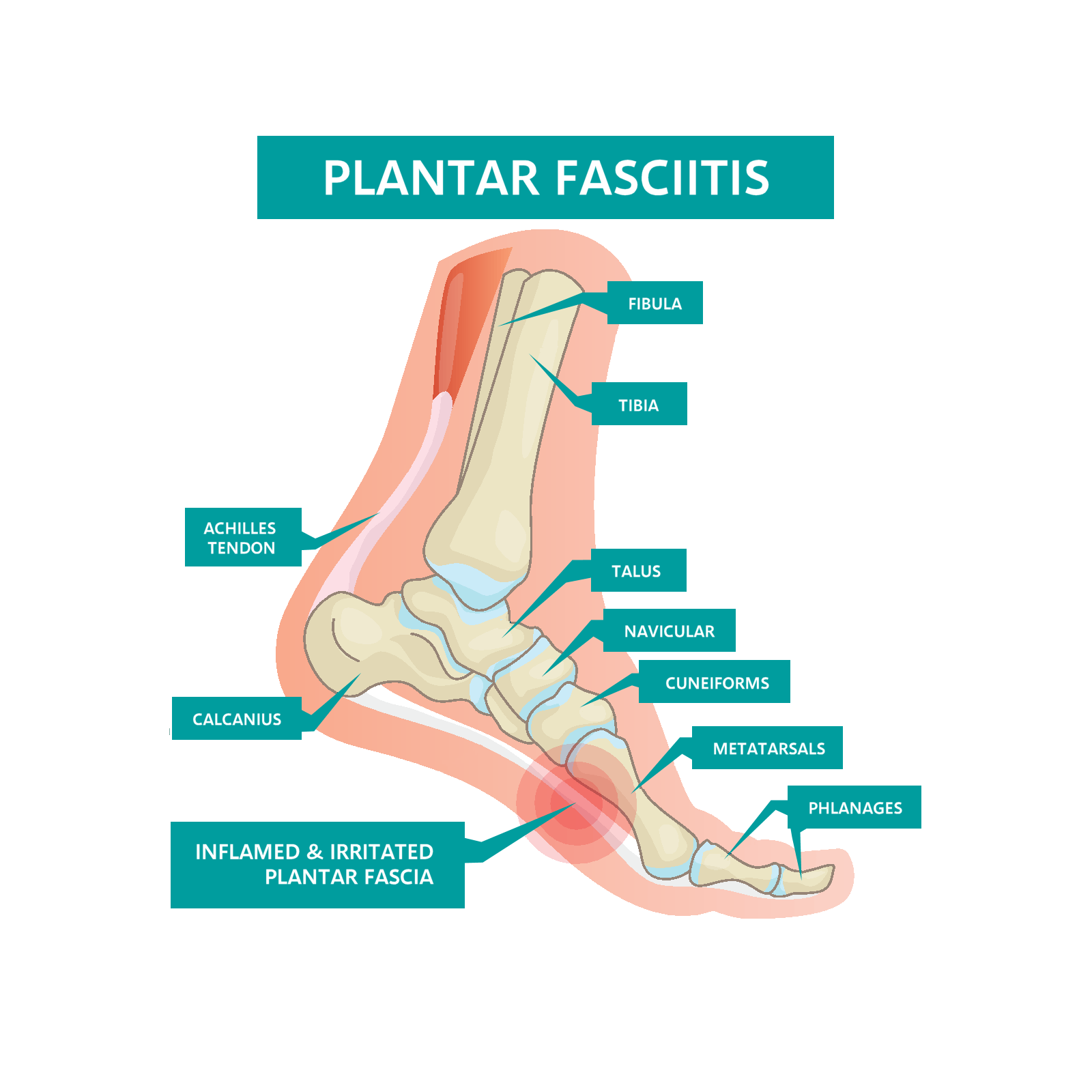 Plantar Fasciitis - Plantar Fasciitis Causes & Treatment