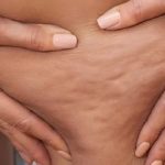 what is cellulite, symptoms and treatment