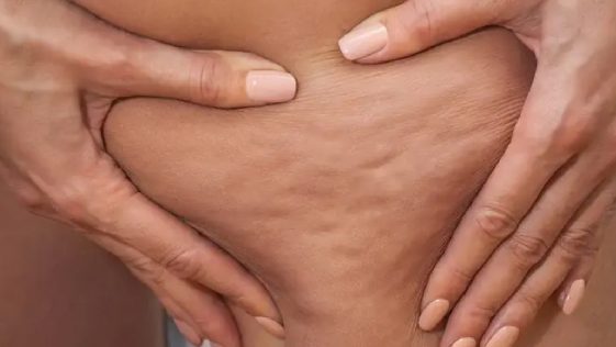 what is cellulite, symptoms and treatment