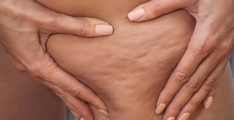 what is cellulite, symptoms and treatment